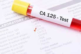 Xét nghiệm CA-125 chẩn đoán bệnh gì? và hướng dẫn đọc kết quả